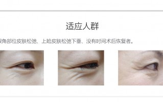 鱼尾纹，鱼尾纹图片